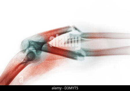 x-ray zeigt eine stark abgewandelte und zerkleinertem Fraktur des Unterarms Stockfoto