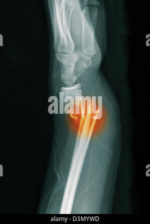 x-ray zeigen eine distale Radius und Ulna Fraktur in ein 12 Jahre altes Mädchen Stockfoto