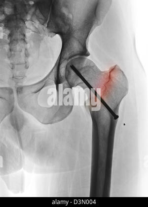 Hip Röntgen zeigt die Reparatur eines gebrochenen Oberschenkelknochen mit einer Schraube Stockfoto