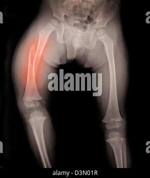 x-ray zeigt eine Femur Fraktur in ein 3 Jahre alter Junge, ein Opfer von Kindesmissbrauch Stockfoto