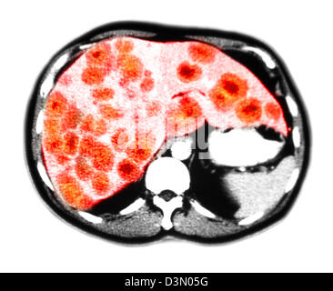 CT-Scan Scheiben zeigen umfangreiche metastasierendem Leberkrebs Stockfoto