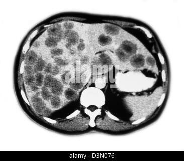 CT-Scan Scheiben zeigen umfangreiche metastasierendem Leberkrebs Stockfoto