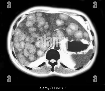 CT-Scan Scheiben zeigen umfangreiche metastasierendem Leberkrebs Stockfoto