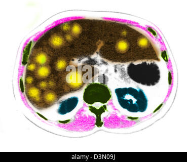 CT-Scan Scheiben zeigen umfangreiche metastasierendem Leberkrebs Stockfoto
