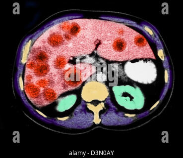 CT-Scan Scheiben zeigen umfangreiche metastasierendem Leberkrebs Stockfoto