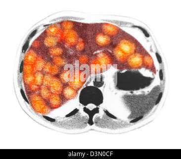 CT-Scan Scheiben zeigen umfangreiche metastasierendem Leberkrebs Stockfoto