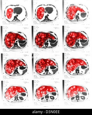 CT-Scan Scheiben zeigen umfangreiche metastasierendem Leberkrebs Stockfoto