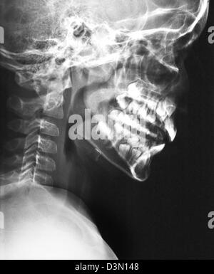 seitliche Schädel Röntgen eines Kindes, die die Entwicklung der Erwachsenen Zähne Stockfoto