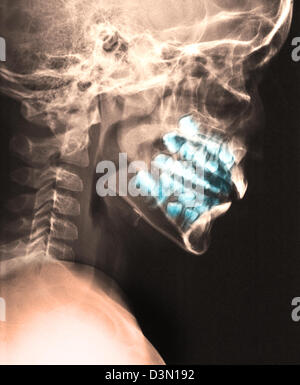 seitliche Schädel Röntgen eines Kindes, die die Entwicklung der Erwachsenen Zähne Stockfoto