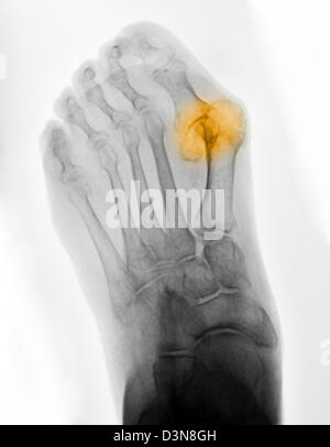 Röntgen des Fußes eine 83 Jahre alte Frau, die eine schweren Hallux valgus Deformität Stockfoto