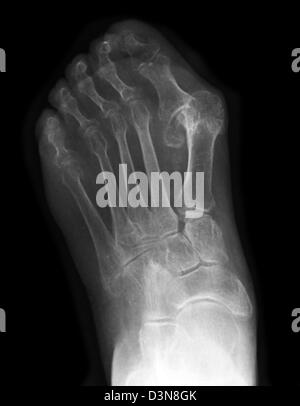 Röntgen des Fußes eine 83 Jahre alte Frau, die eine schweren Hallux valgus Deformität Stockfoto