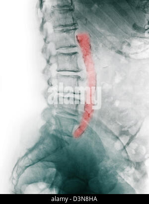 x-ray eine 81 Jahre alte Frau, die eine verkalkte Aorta aus atherosklerotische Herzkrankheit Stockfoto