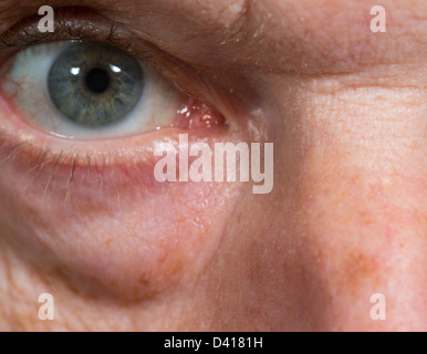 Makro Nahaufnahme des Auges von einem senior kaukasischen Mann mit Falten und Tränensäcke unter den Augen Stockfoto