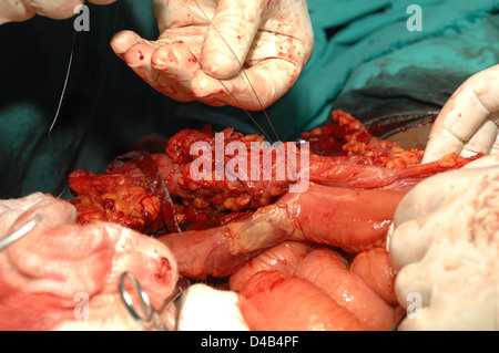 Faserige Haftung des Dickdarms. Close-up Stockfoto