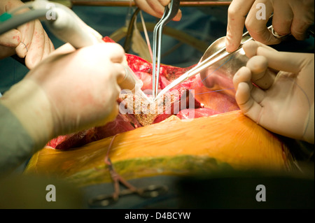 Chirurgen, die Durchführung einer Lebertransplantation am Samsung Medical Centre. Stockfoto