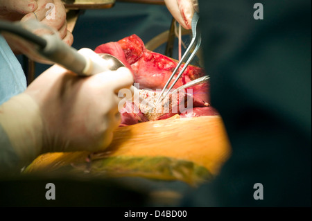 Chirurgen, die Durchführung einer Lebertransplantation am Samsung Medical Centre. Stockfoto