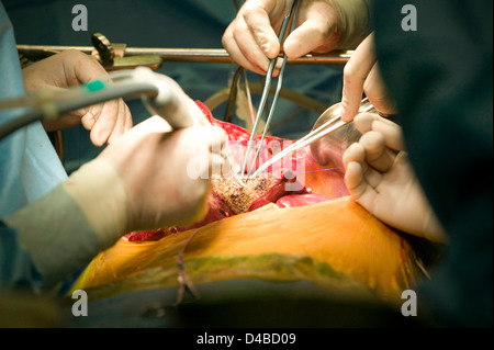 Chirurgen, die Durchführung einer Lebertransplantation am Samsung Medical Centre. Stockfoto