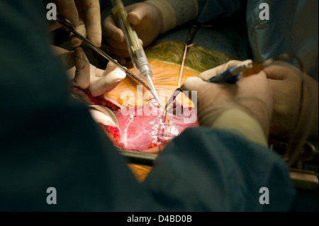 Chirurgen, die Durchführung einer Lebertransplantation am Samsung Medical Centre. Stockfoto