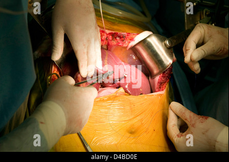 Chirurgen, die Durchführung einer Lebertransplantation am Samsung Medical Centre. Stockfoto