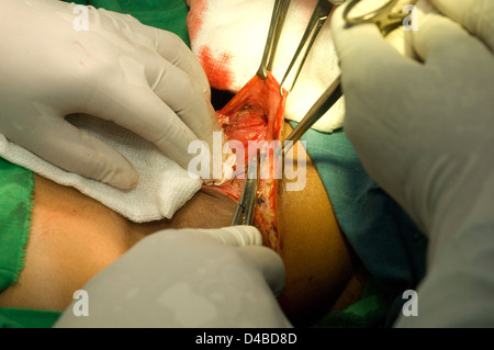 Thyreoidektomie. Assistent hält Allis Klemmen Haut zurückziehen, während Chirurgen Anker lose Subcutaenous Gewebe Kanten Wunde bereitet. Stockfoto