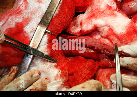 Nahaufnahme einer Magen Leistenbruch Operation zeigt mehrere medizinische Instrumente und Chirurgen Hände Stockfoto