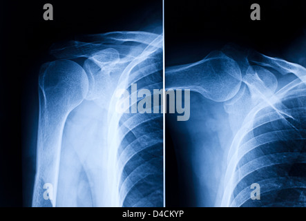 Bild der Schulter blau xray Stockfoto