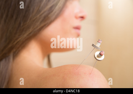 Moxibustion Akupunktur Nadeln Hitze auf Frau Schulter closeup Stockfoto