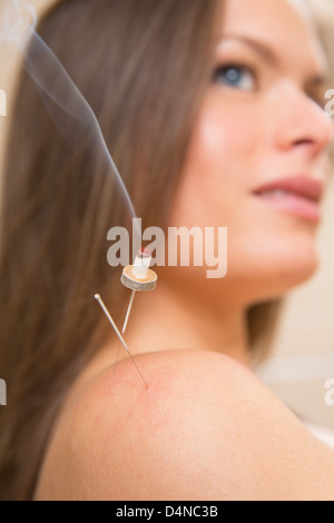 Moxibustion Akupunktur Nadeln Hitze auf Frau Schulter closeup Stockfoto