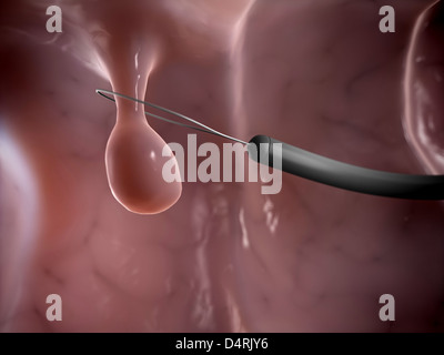Polypen-Entfernung Stockfoto