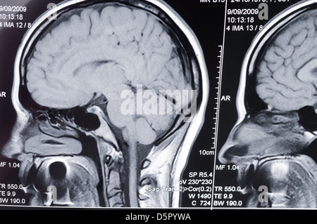 Nahaufnahme eines Computer axiale Tomographie Scans (CT) des Kopfes Stockfoto