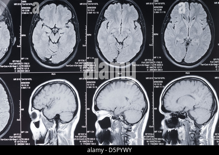 Nahaufnahme eines Computer axiale Tomographie Scans (CT) des Kopfes Stockfoto