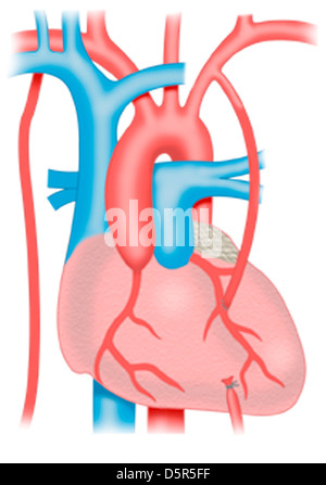 Coronary Artery Bypass Stockfoto