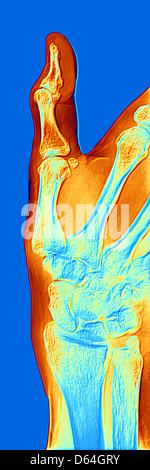 Arthrose der Hand, x-ray Stockfoto