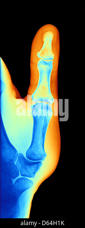 Arthrose der Hand, x-ray Stockfoto