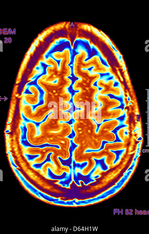 Gehirn-Scan, MRI scan Stockfoto