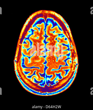 Gehirn-Scan, MRI scan Stockfoto