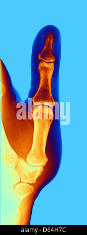 Arthrose der Hand, x-ray Stockfoto