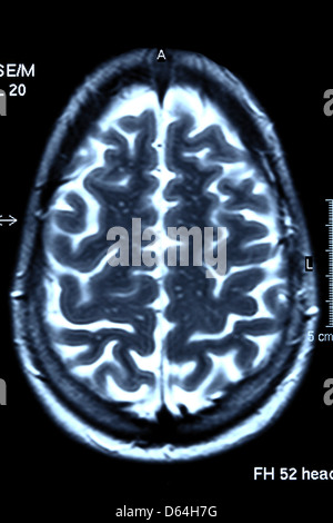 Gehirn-Scan, MRI scan Stockfoto