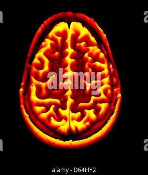 Gehirn-Scan, MRI Scan, heightmap Stockfoto