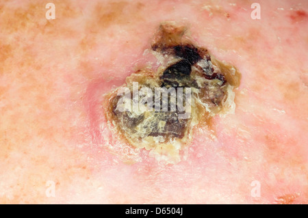Hautkrebs Stockfoto