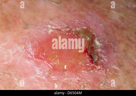 Hautkrebs Stockfoto