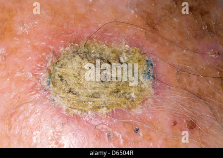 Hautkrebs Stockfoto