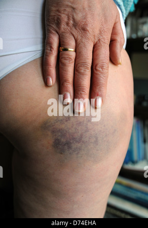 Frau zeigt Verletzungen mit schweren Prellungen am Oberschenkel Bereich des Beines nach einem Sturz der Haut Stockfoto
