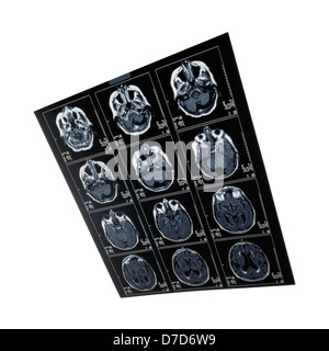 Röntgenbild des Gehirns Computertomographie Stockfoto