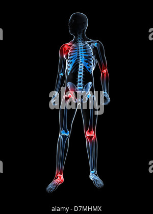 Gelenkschmerzen, konzeptuellen Kunstwerk Stockfoto