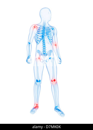 Gelenkschmerzen, konzeptuellen Kunstwerk Stockfoto