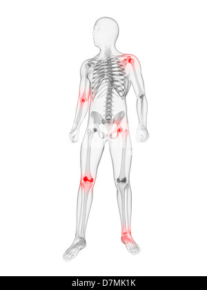 Gelenkschmerzen, konzeptuellen Kunstwerk Stockfoto