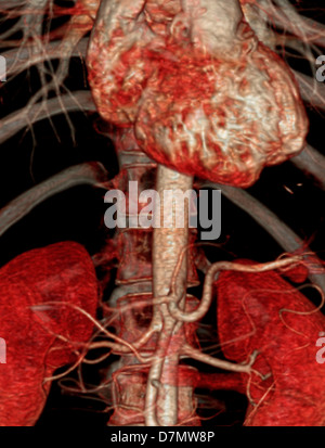 Bauchaorta, 3D CT-scan Stockfoto