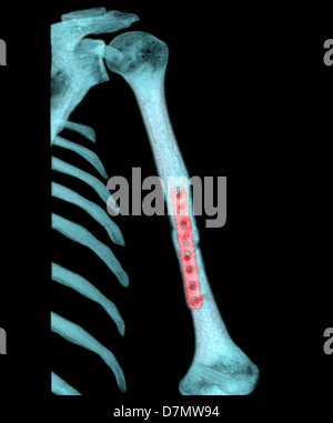 Fixierten Arm Bruch, 3D CT-scan Stockfoto