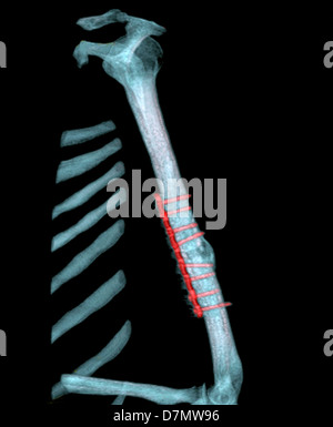 Fixierten Arm Bruch, 3D CT-scan Stockfoto